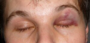 black eye